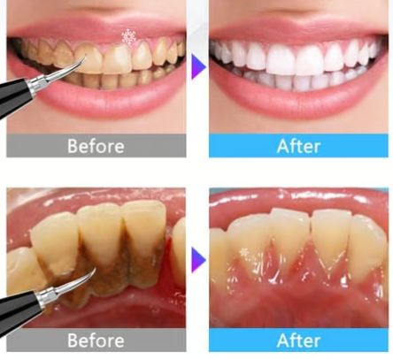 Ultrasone Tandsteen Verwijderaar