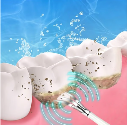 Ultrasone Tandsteen Verwijderaar